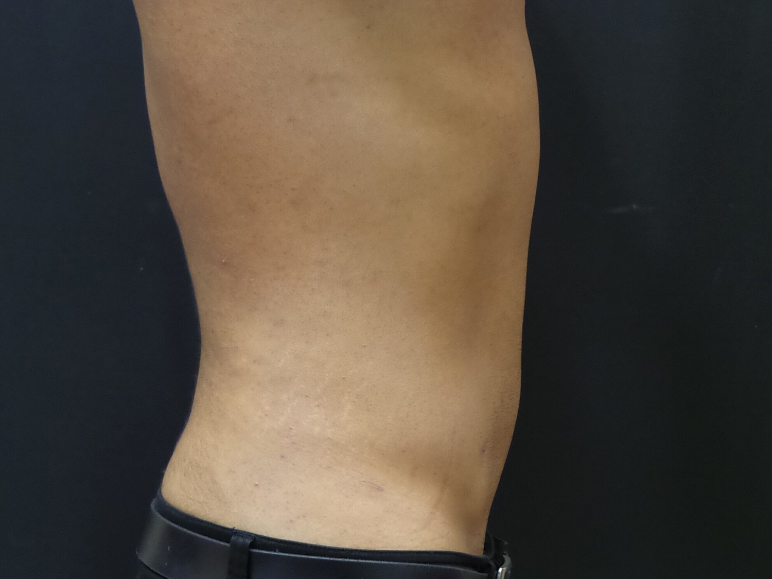 Liposuction Before & After