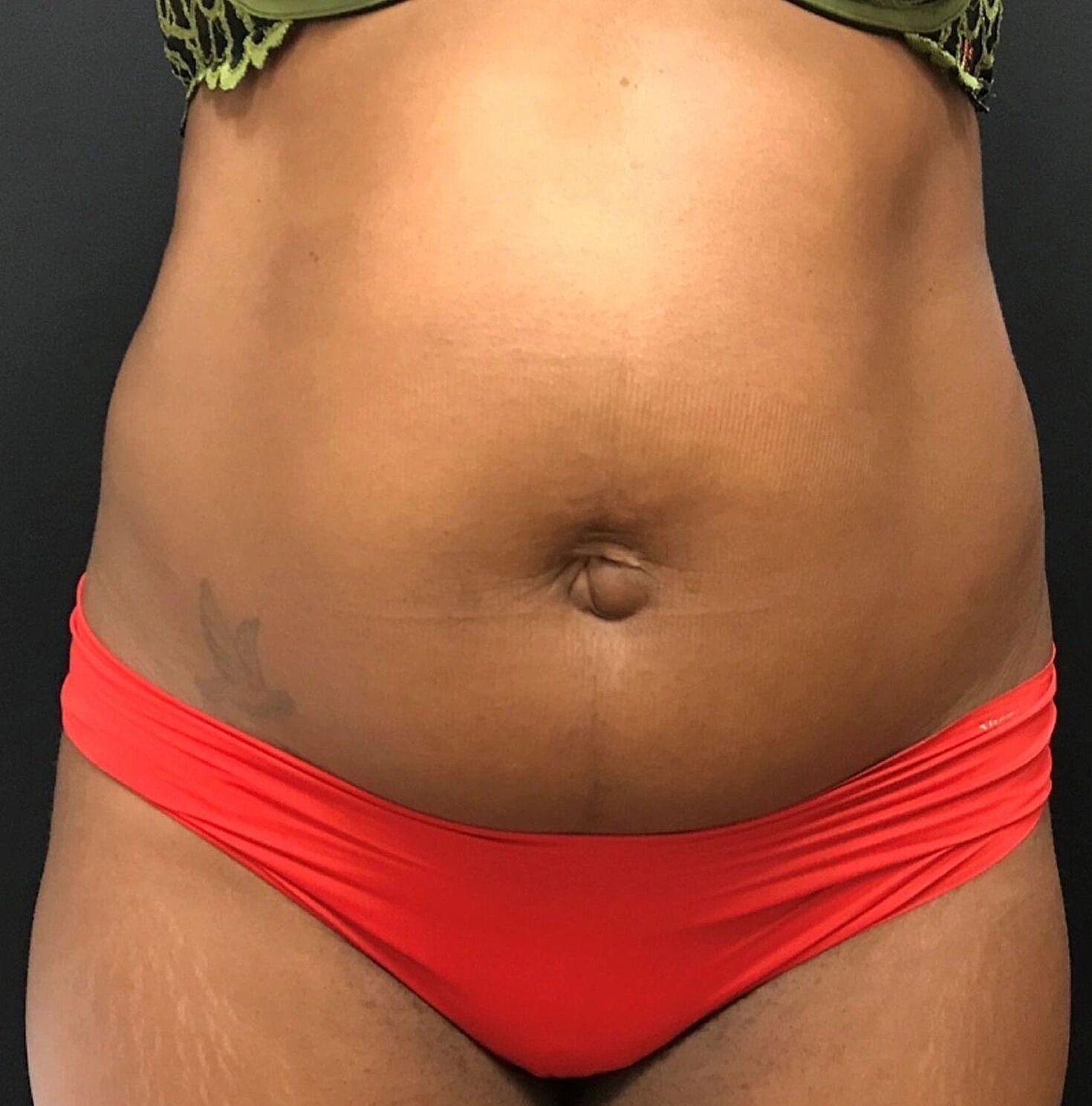 Liposuction Before & After