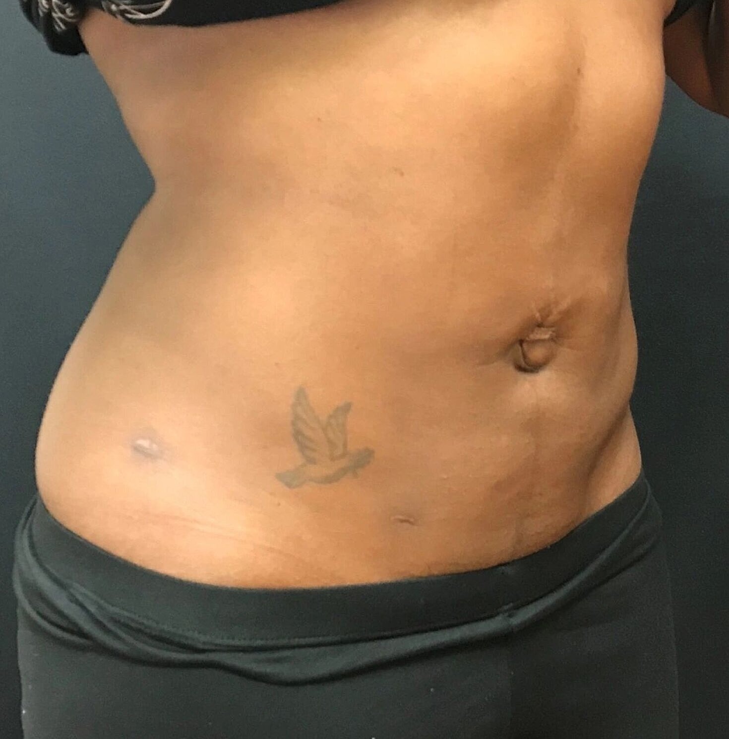 Liposuction Before & After