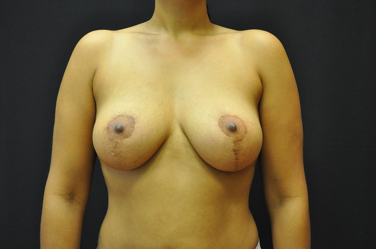 Breast Lift Before & After