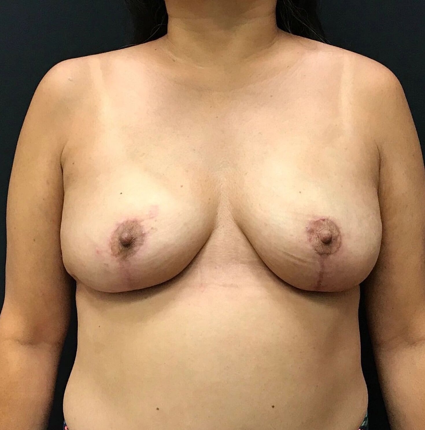 Breast Lift Before & After
